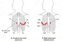 leads ecg placement