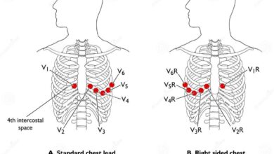leads ecg placement
