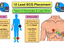 leads for ekg