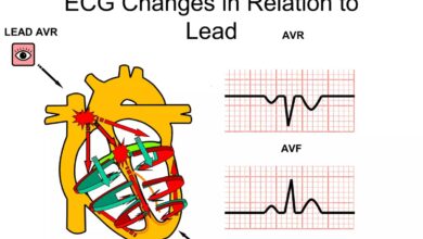 leads on ecg